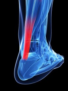650_1000_tendon-aquiles